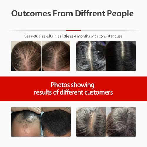 Laser Hair Growth Cap, Red Light Therapy for Hair Regrowth, Laser Therapy Cap for Hair Loss, Hair Loss Treatments Hat for Men & Women