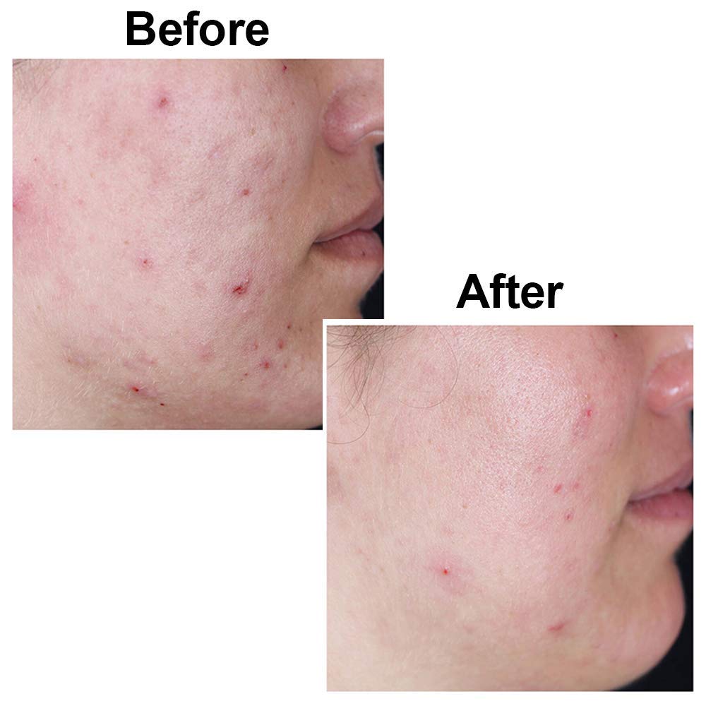 Kojie San Skin Brightening 2 Piece Set - The Original Kojic Acid Soap that Reduces Dark Spots, Hyperpigmentation, and Other types of Skin Damage – 65g x 2 Bars & 30g Face Cream
