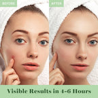 Absorbing Cover Healing Invisible Acne Patch Blemish Spot, Treatment, Facial Acne Patch Vegan, Cruelty Free, Hydrocolloid, Two Sizes 10mm 12mm (Total 84 Counts)
